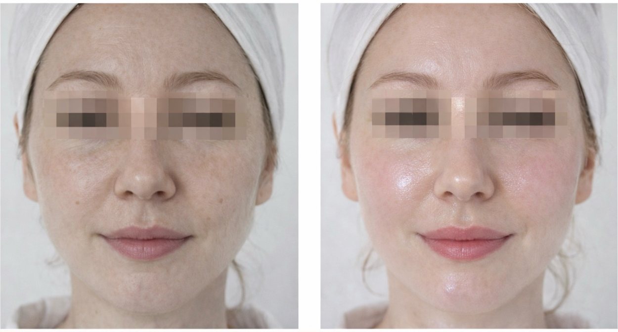 A woman's face, eyes obscured, before and after four weeks of use