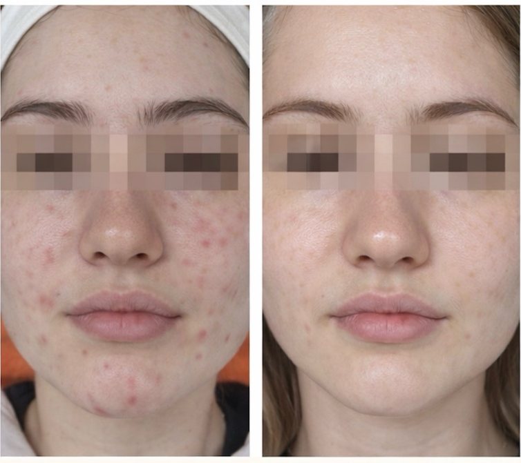 A young woman's face, eyes obscured, before and after eight weeks of use