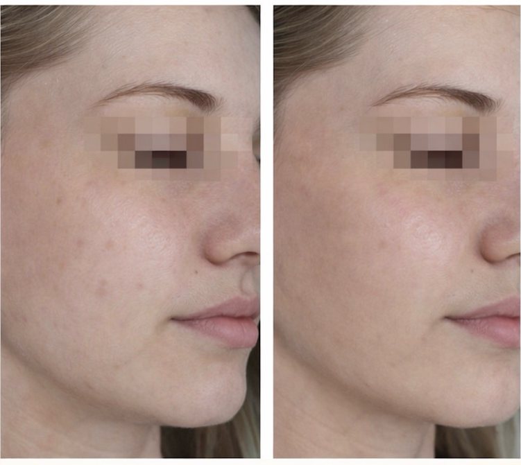 A woman's face in profile, eyes obscured, before and after eight weeks of use