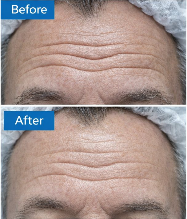 Forehead of a man in his 60s, before and after two weeks of use