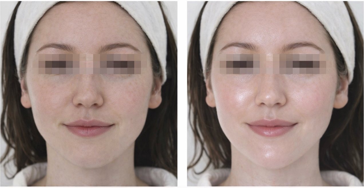 A woman's face, eyes obscured, before and after four weeks of use